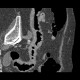 Diverticulitis of sigmoid colon, fistula, abscess: CT - Computed tomography